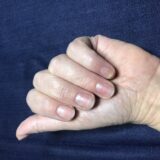 Paznokieć - Alergia na lakiery hybrydowy zdjęcie paznokcia - alergia na lakiery hybrydowy