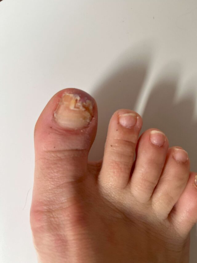 PAZNOKIEĆ ZMIENIONY CHOROBOWO