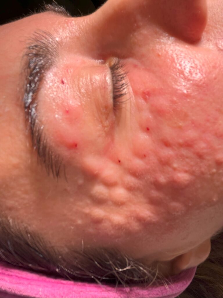 Mezoterapia okolicy Oka